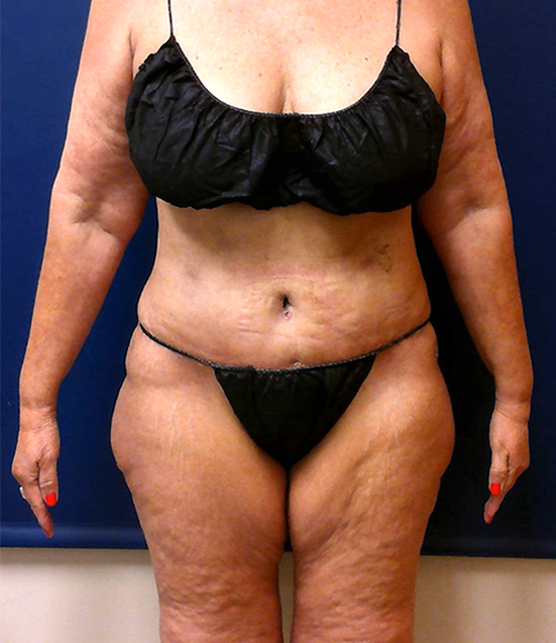After Tummy Tuck Photo