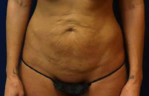 Abdominoplasty