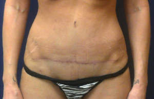 Abdominoplasty