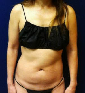 Abdominoplasty