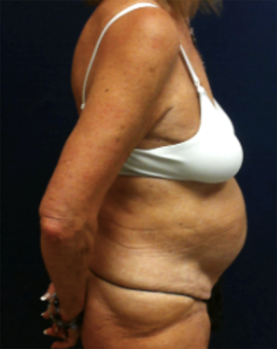 Abdominoplasty